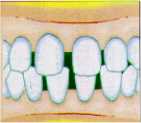歯列矯正すきっ歯