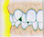 歯列矯正八重歯