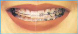 歯列矯正透明装置